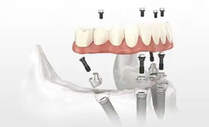 福州马泷齿科特色项目与价格体系