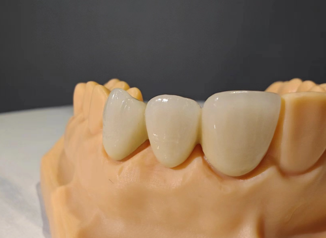 义佳微纳熔覆义齿可以做磁共振吗?可以,钛合金材质1300元,医院100%通过