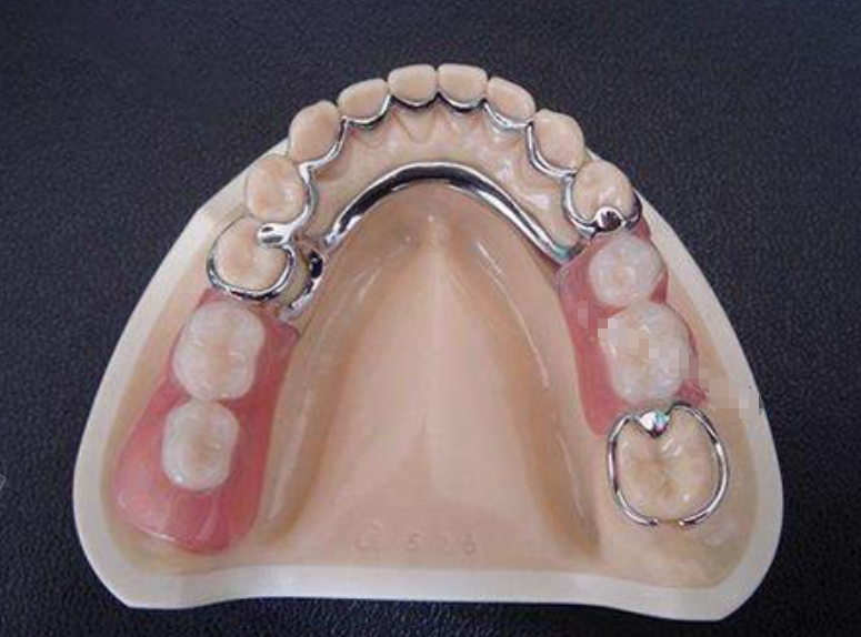 义佳微纳熔覆义齿适用人群与注意事项