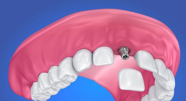 三、骨粉骨膜纳入集采带来了哪些影响？