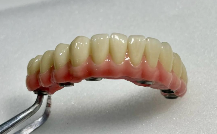 什么是马龙桥种植牙？别搞错！是缺牙多颗且骨量够的连桥种植方案不花冤枉钱