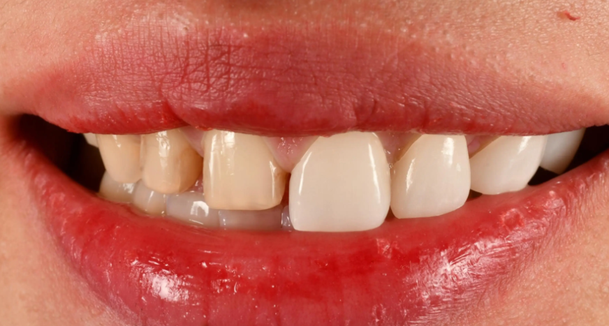 医生对于日本再生牙技术有哪些建议？