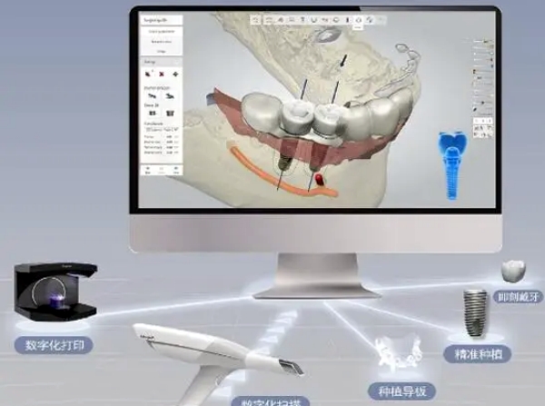 二、登腾种植牙的五大技术优势