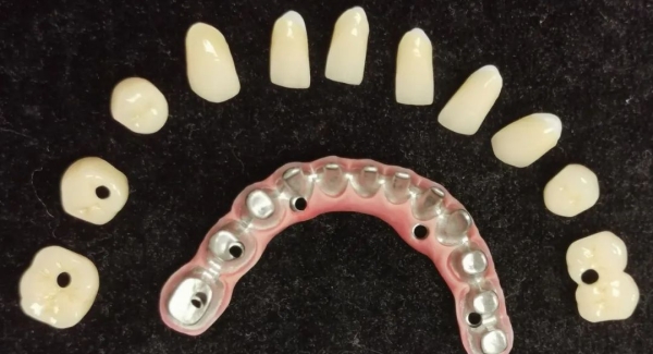 一、什么是马龙桥种植牙——概念解析