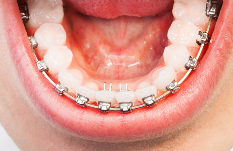 六、欧欧球面自锁托槽的技术创新