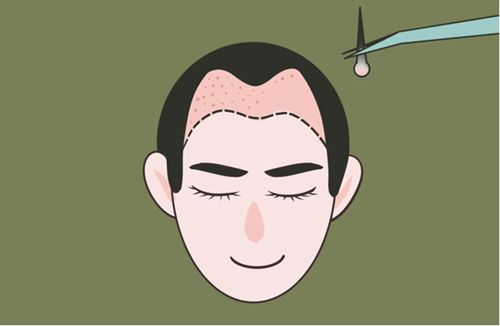 三、科学替代方案：发际线修复的正确打开方式