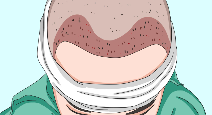 五、络腮胡毛囊植发常见问题解答