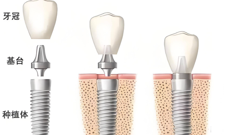 三、大清西格种植体技术特点与优势