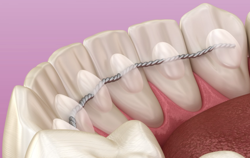 一、松牙固定术治疗几次？取决于多种因素