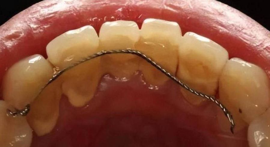 四、松牙固定术有哪些治疗方法？