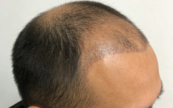 脱发1-7级原因有哪些