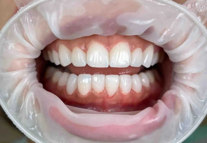 五、佛山登特口腔全瓷贴片术后护理及注意事项