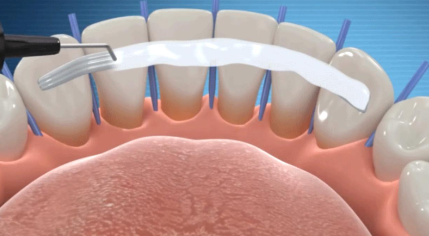 三、松牙固定术的固定疗效与时限是怎样的？