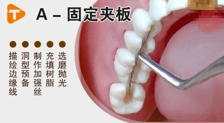 五、不同松牙固定技术该如何对比与选择？