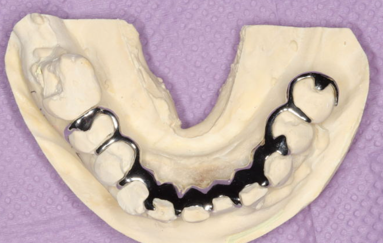 六、患者关于松牙固定术有哪些常见问题？