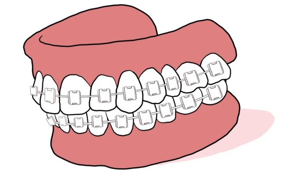 二、从材料差异细看遵义牙科医院矫正牙齿价格表