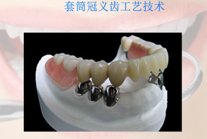 一、套筒冠和精密附着体的基本概念是怎样的？