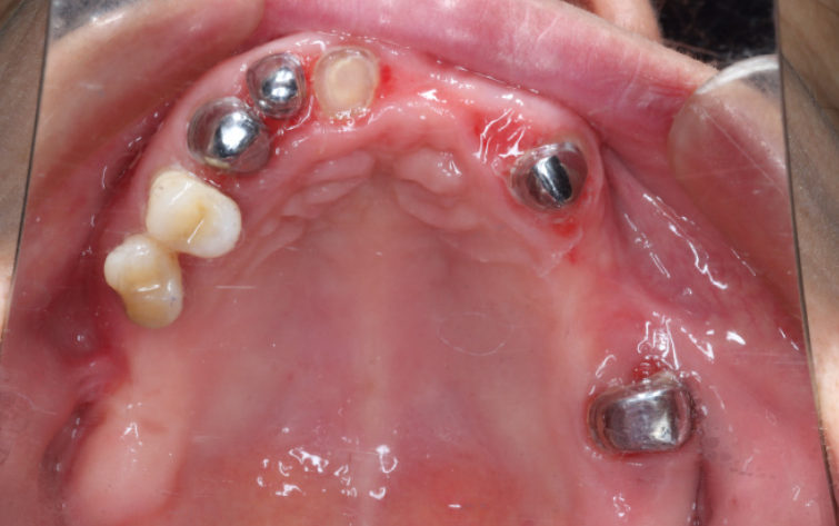 三、套筒冠和精密附着体在临床研究数据上有什么差异？