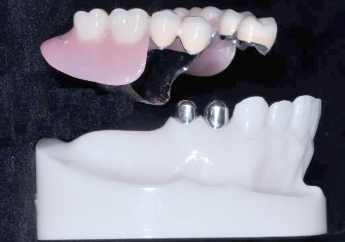 五、使用套筒冠和精密附着体有哪些注意事项？