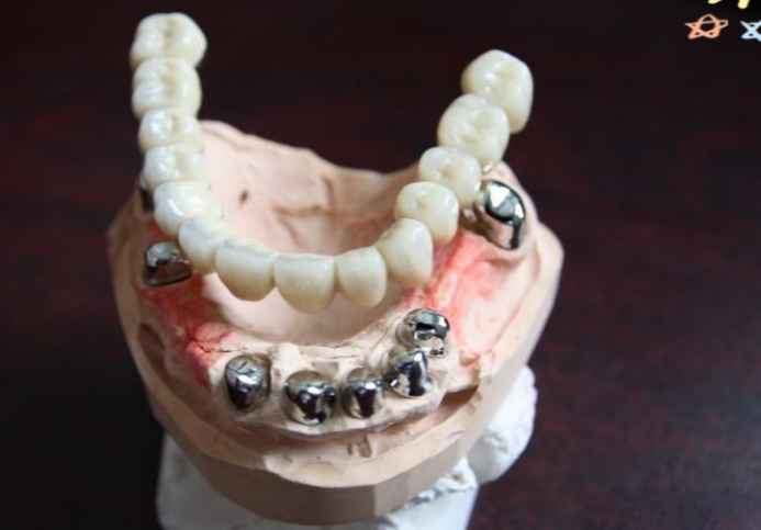 四、套筒冠义齿适合哪些情况，又有哪些禁忌呢？