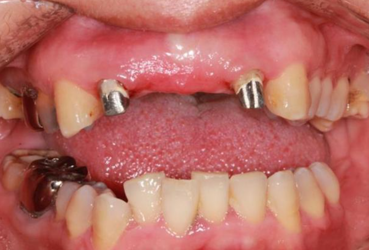 六、医生对套筒冠义齿有哪些看法呢？