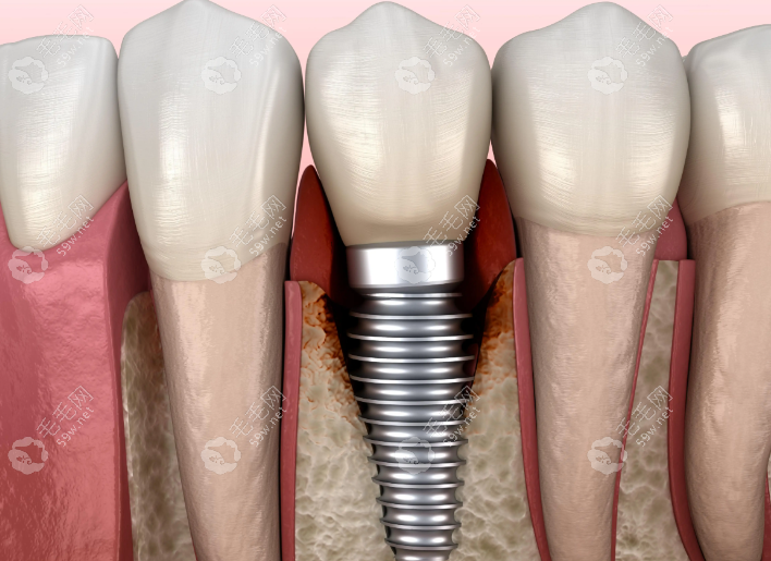 种植牙修复项目