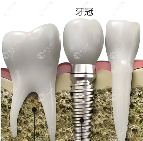 单颗种植牙要包含牙冠