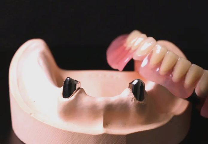 二、套筒冠义齿的优点是什么？