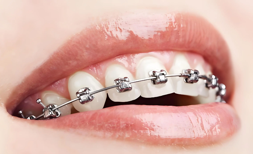 四、好必特自锁托槽术后护理要点www.59w.net