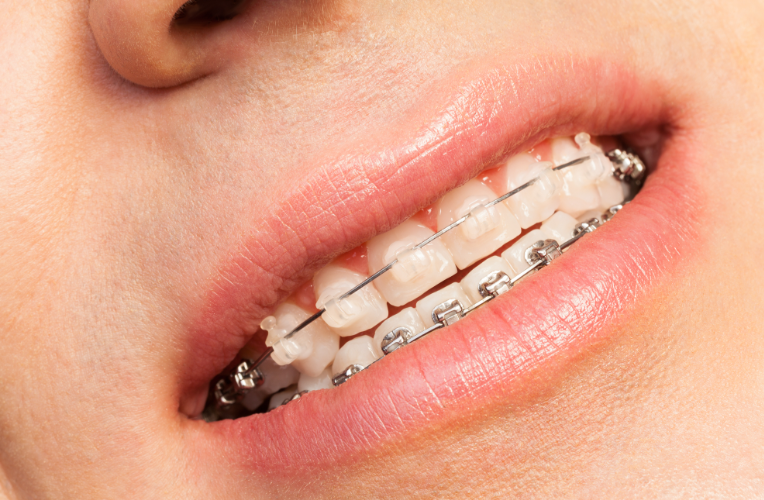 五、好必特自锁托槽预约流程指南