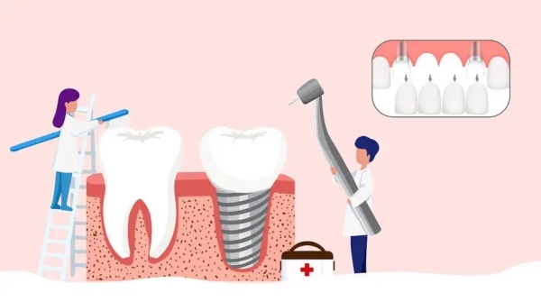 dio种植体怎么样