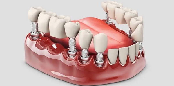 四、如何选择适合自己的种植牙医院