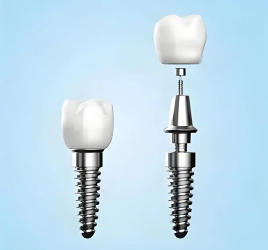 二、不同品牌的种植体可以混种吗?影响混种的关键因素