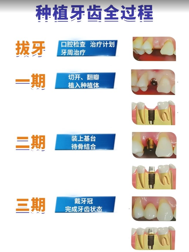dio种植体还值得买吗？韩国进口2000元起，骨结合快性价比高