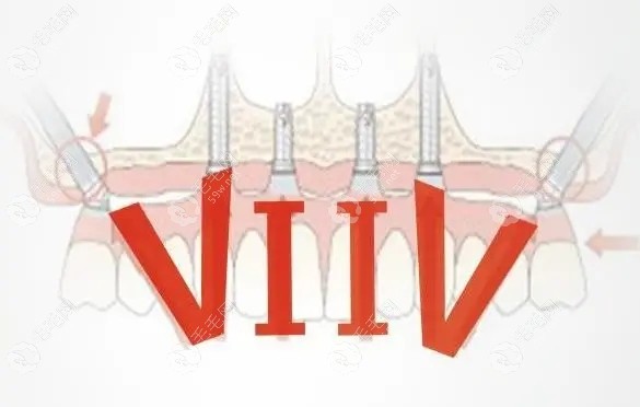 殷杰医生种植牙
