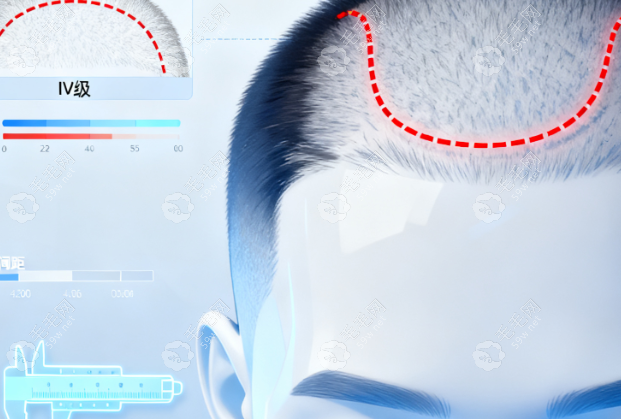 哈尔滨哪个医院植发价格便宜？这5家性价比高不踩坑，满足不同预算 