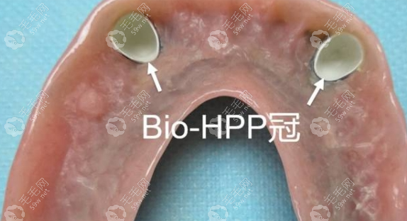 福州镶牙多少钱一颗？爱尔创全瓷1200-1800元单颗，连桥镶牙更有门道