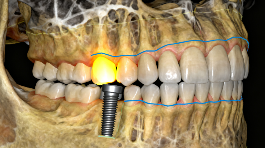 烟台刘芳口腔种植牙