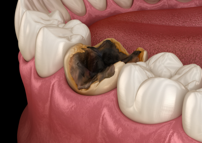 六、杭州富陽區(qū)根管治療術(shù)后注意事項