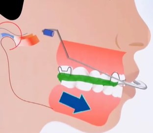 肥乡牙科矫正牙齿多少钱?金属托槽5000起、陶瓷托槽1万起、隐形矫正2万起