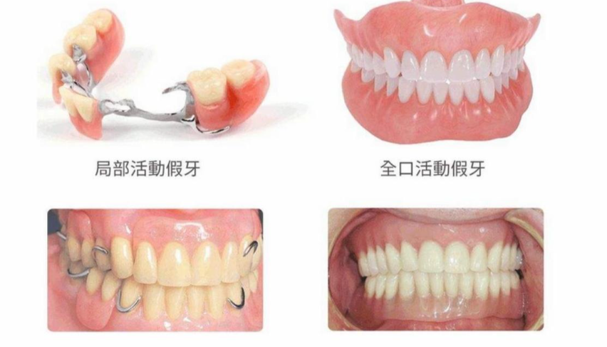 全口吸附义齿使用评价避坑：别信“秒适应”，前1周有局部压迫感和异物感是正常的