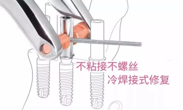 二、不同类型牙齿不种的情况有哪些
