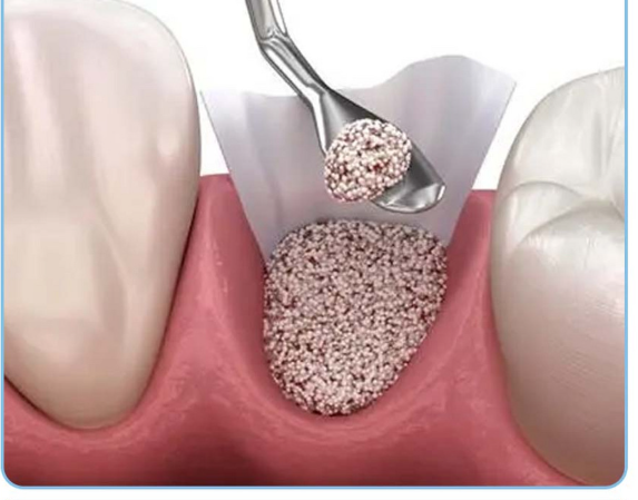 一、种植牙一定要用骨粉吗?植骨粉的风险有多大