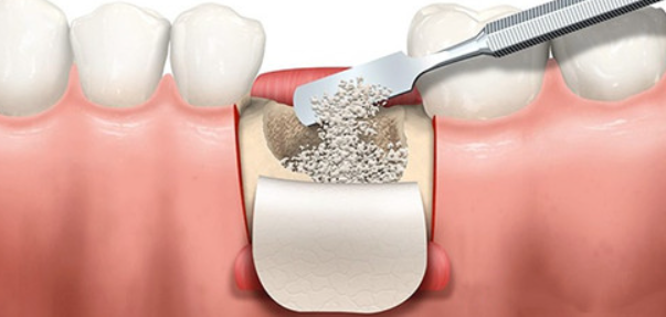 二、种植牙植骨粉的费用与周期问题
