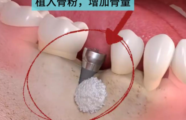 三、种植牙骨粉类型及优缺点www.59w.net