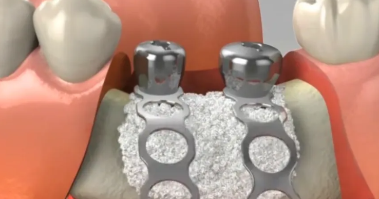 四、种植牙避免过度治疗建议