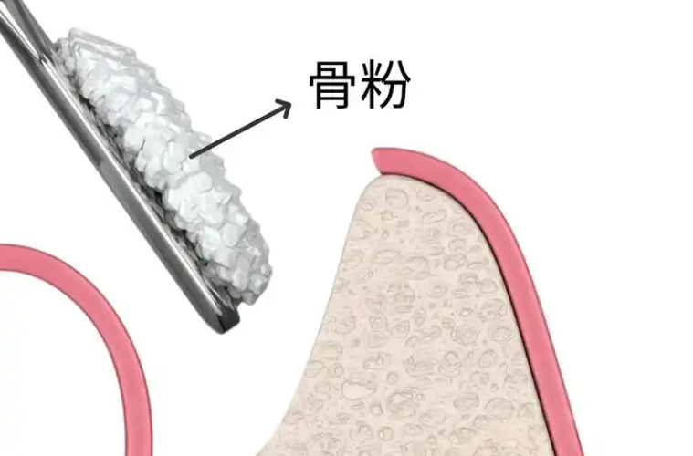 五、种植牙避免植骨的新技术