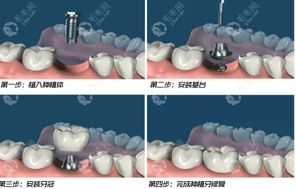 肥城牙科诊所排名前十名单出炉，邢氏牙科等机构上榜，种植牙价格透明