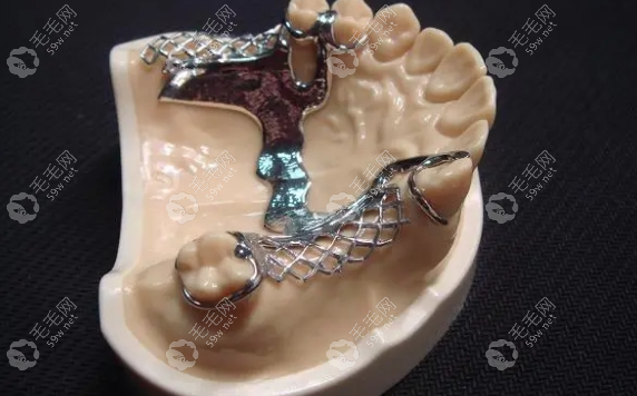 德國(guó)拜耳牙多少錢(qián)一顆？?jī)r(jià)格表+材質(zhì)解析，種牙前必看