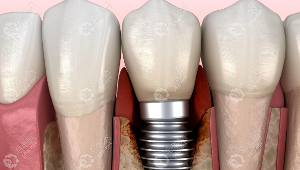 别踩坑！东莞东城好佰年口腔种植牙多少钱？纯钛/亲水表面种植体价格大揭秘